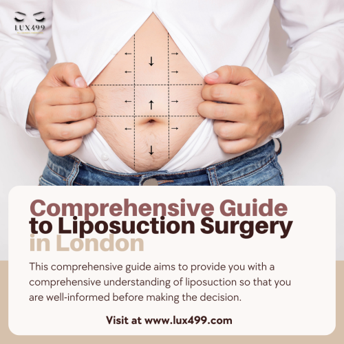 Liposuction surgery in London is not a one-size-fits-all medical treatment. Those who are the following are typically good candidates for liposuction: possess confined fat deposits that are unresponsive to exercise and diet. are generally in good health and have reasonable hopes for the result. For best effects, have skin that is elastic and firm. want to address particular areas of concern but are at or near their ideal weight.
https://lux499.com/blog/A-Comprehensive-Guide-to-Liposuction-Surgery-in-London