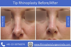Tip-Rhinoplasty-Before-and-Afterd81867225bed5347.jpg