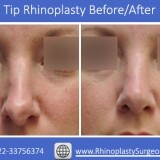 Tip-Rhinoplasty-Before-and-Afterd81867225bed5347