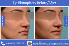 Tip-Rhinoplasty-surgery-of-a-Patient73bc48fdc826edd8.jpg