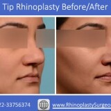 Tip-Rhinoplasty-surgery-of-a-Patient73bc48fdc826edd8
