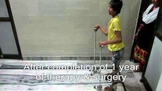 Treatment-for-Paediatric-Disabilities--Orthopaedic-Problems-Trishla-Foundation00a9f70fafc31023.jpg