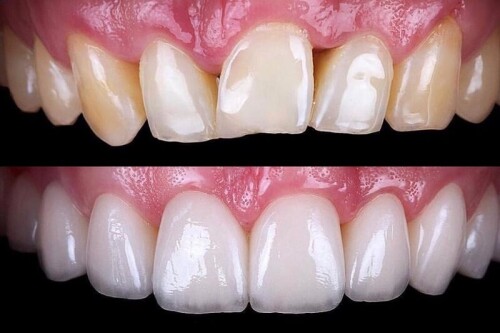 Reveal Dental in Cedar Park can show you the transformational potential of porcelain veneers. Elevate your confidence and get the smile you've always dreamed of. Book Your Consultation Today!