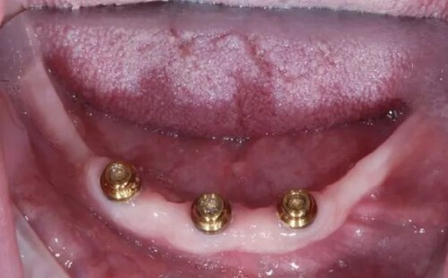 Dental Implants