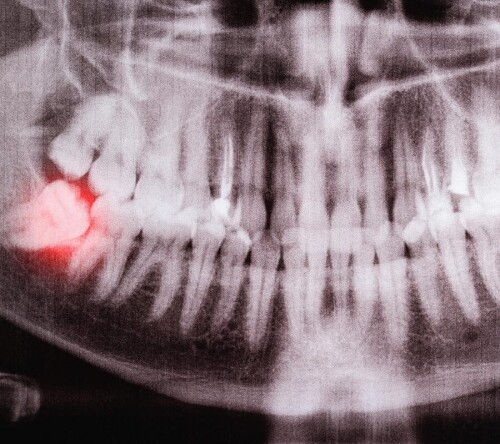 Wisdom-Teeth-Removalfcf4e54c6dccbfec.jpg