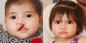 Facial-Deformities-Cleft-Lip--Palate-Surgery9ec123e46cb2674f.jpg