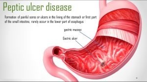 Know-more-about-Esophageal-Peptic-Ulcer--Pancreas-Surgeries96c9a22a16a15b8c.jpg