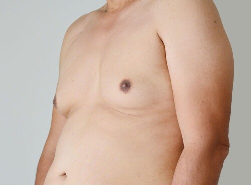 imgi_1_Gynecomastiabbccd932fb50f537.jpg