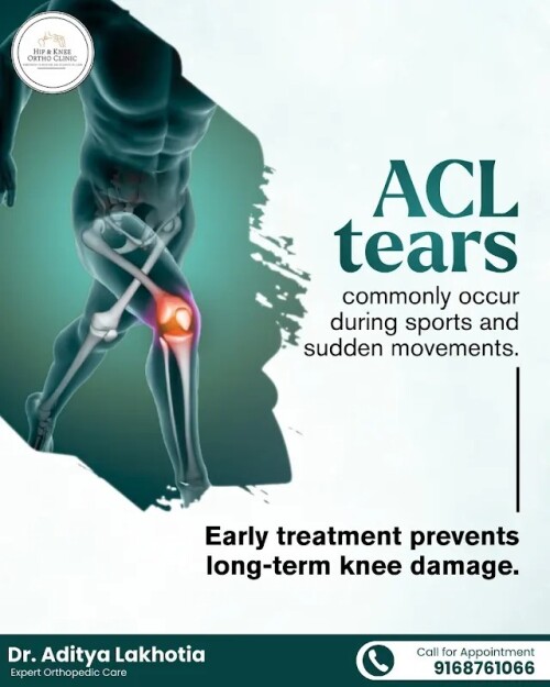 Preventing-Long-Term-Damage-Understanding-ACL-Tears-in-Sportsa682246d974f9f97.jpg