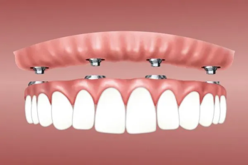 All-On-X-Dental-Implants-Melbourne8c91f587aee3b6aa.png