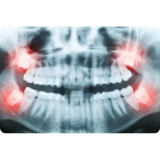 Wisdom-Teeth-Surgery-Melbourned757c118744fcacb.png